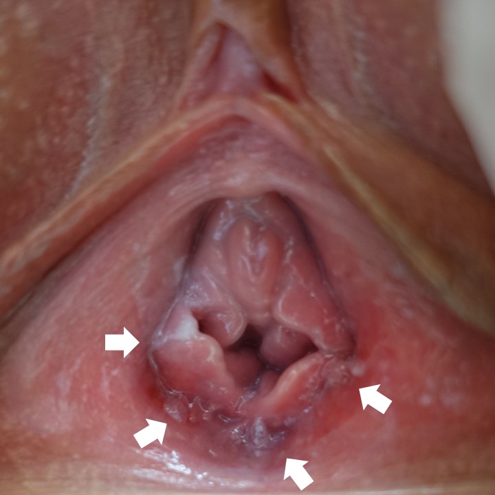 膣前庭部、尿道の尖圭コンジローマ