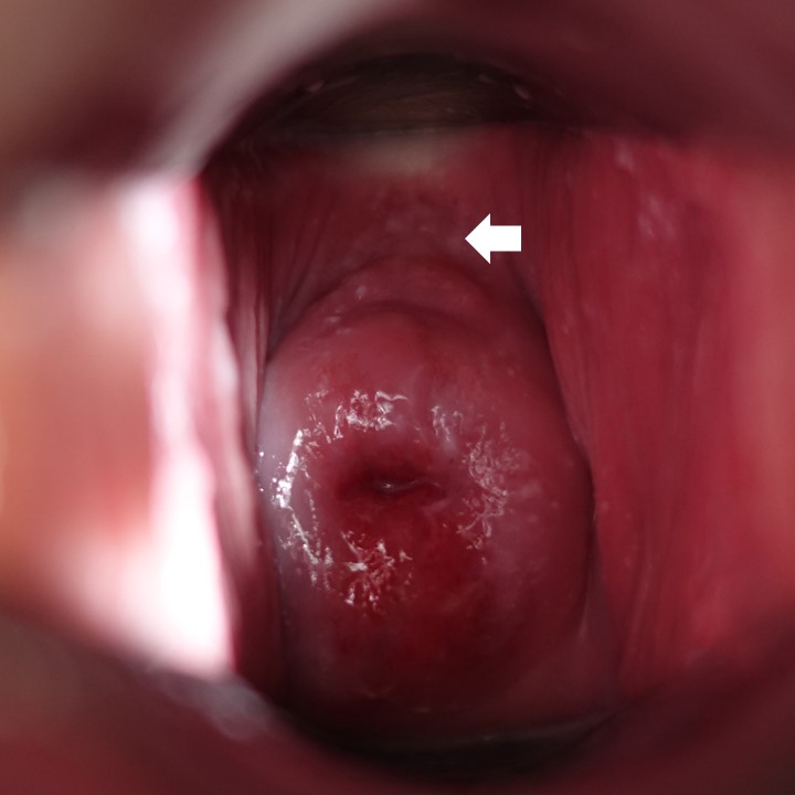 膣前庭部、膣口、膣天蓋部　尖圭コンジローマ