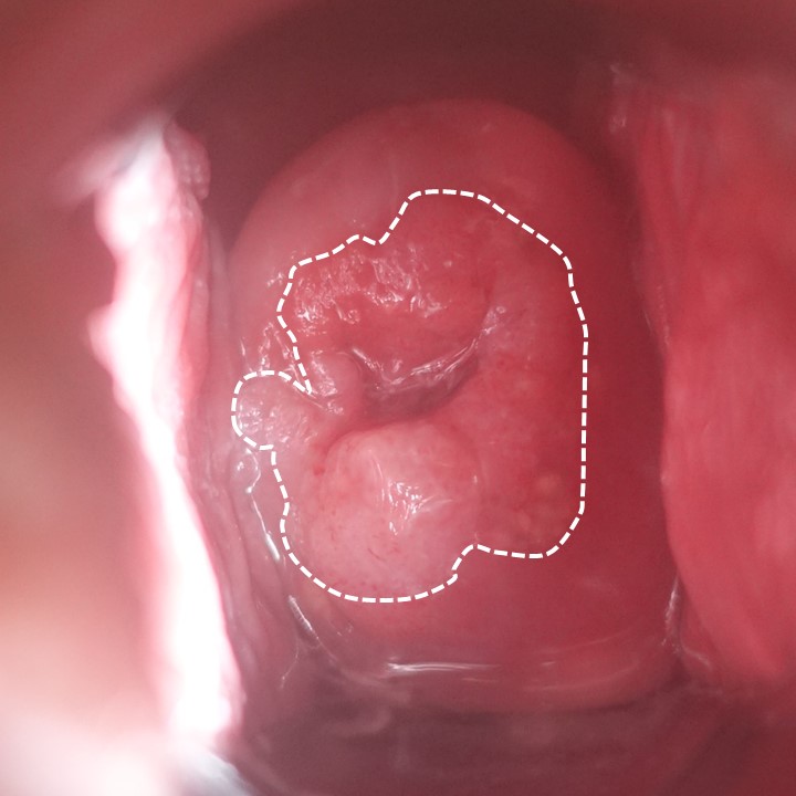ピンサロの指入れにより外陰部、肛門周囲、子宮頚部尖圭コンジローマを発症した一例