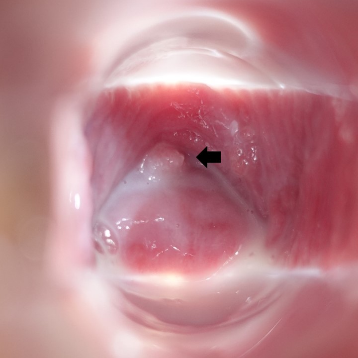 膣前庭部、膣口、膣天蓋部　尖圭コンジローマ