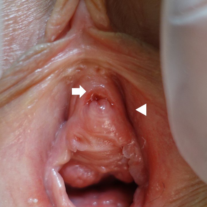 処女膜、尿道近傍膣前庭部、尿道の尖圭コンジローマ