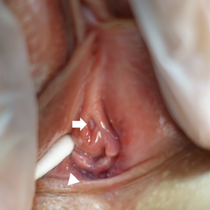 膣前庭部から尿道にまで発展し、治療に半年を要した尖圭コンジローマの一例