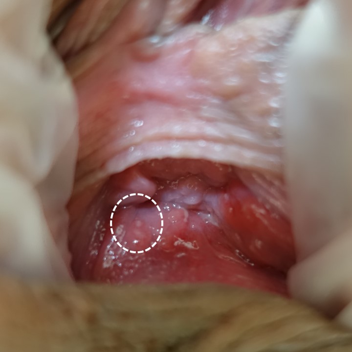 外陰部にわずかな潰瘍しか認めない性器ヘルペスの一例