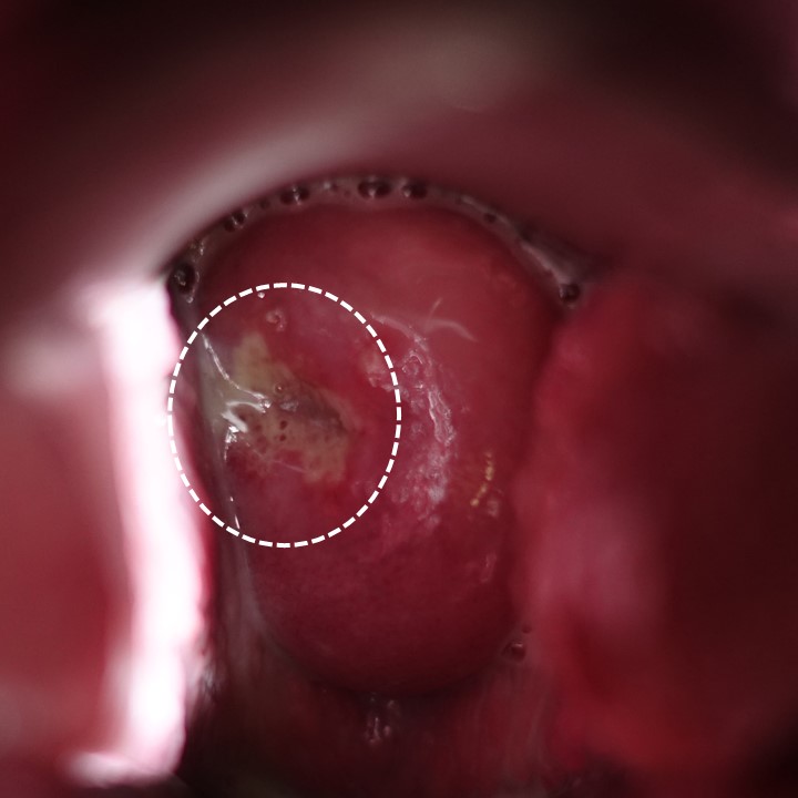 外陰部にわずかな潰瘍しか認めない性器ヘルペスの一例
