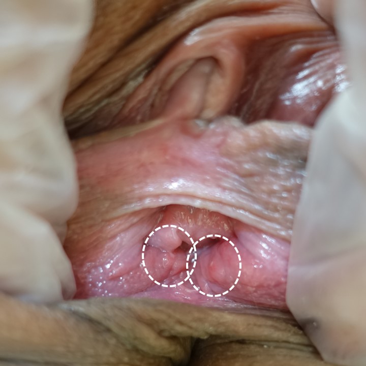 外陰部にわずかな潰瘍しか認めない性器ヘルペスの一例