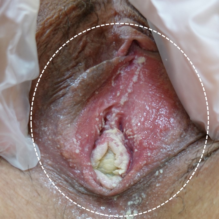 唾液を付けた指での指入れにて誘発された膣カンジダ症の一例