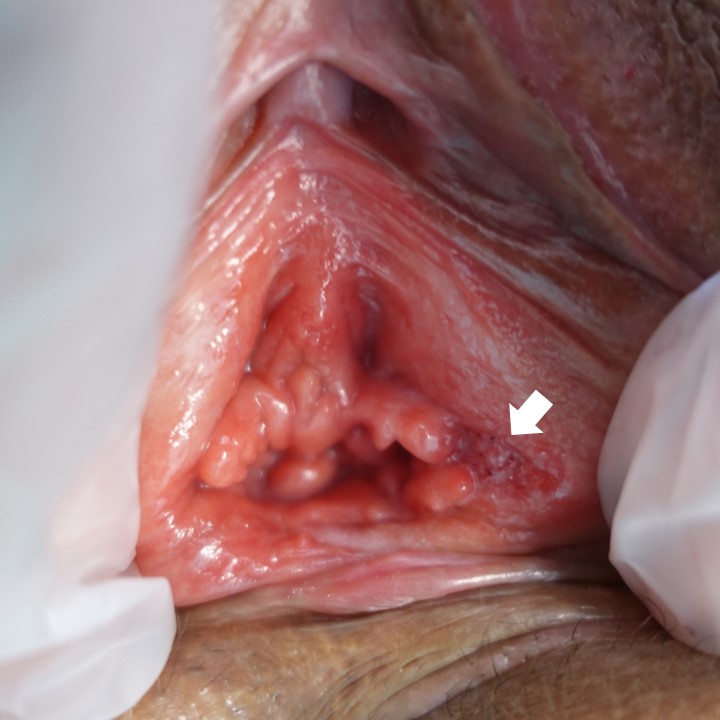 膣前庭部に無数に認めるコンジローマのイボが2週間の治療で消失した一例