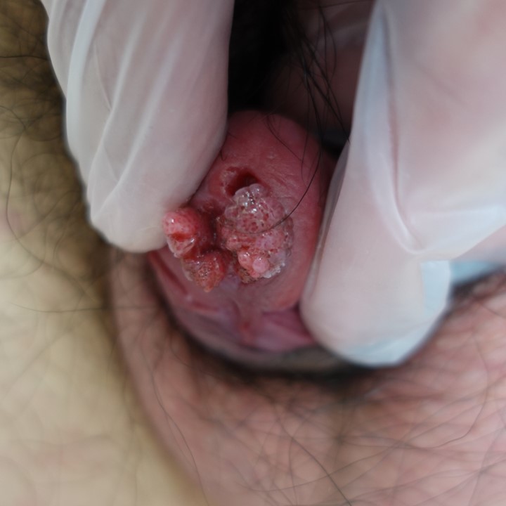尿道（下裂）に発症した粗大尖圭コンジローマにより出血と排尿障害を来した一例