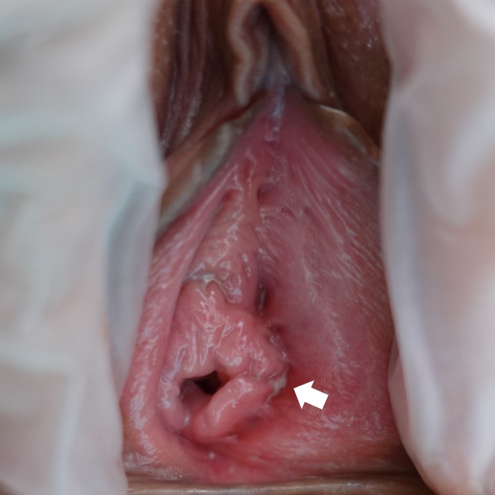 夜のストレッチの時に鼠径部の痛みを感じ、のど・膣・バルトリン腺から淋菌が検出された一例
