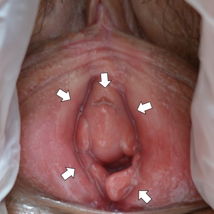 独特の臭いのするオリモノで発見された膣トリコモナス症の一例