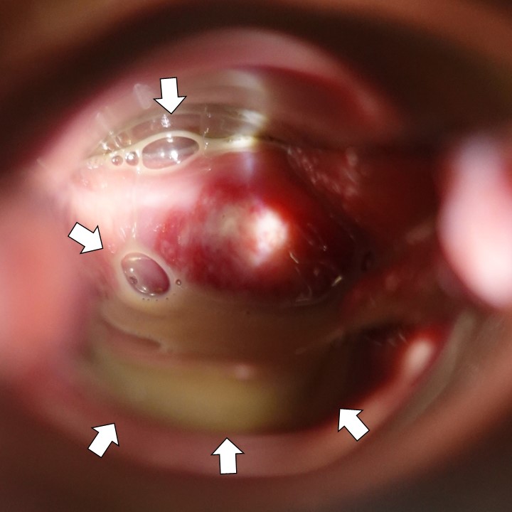 抗原検査陰性だが、性器ヘルペスを強く疑う一例