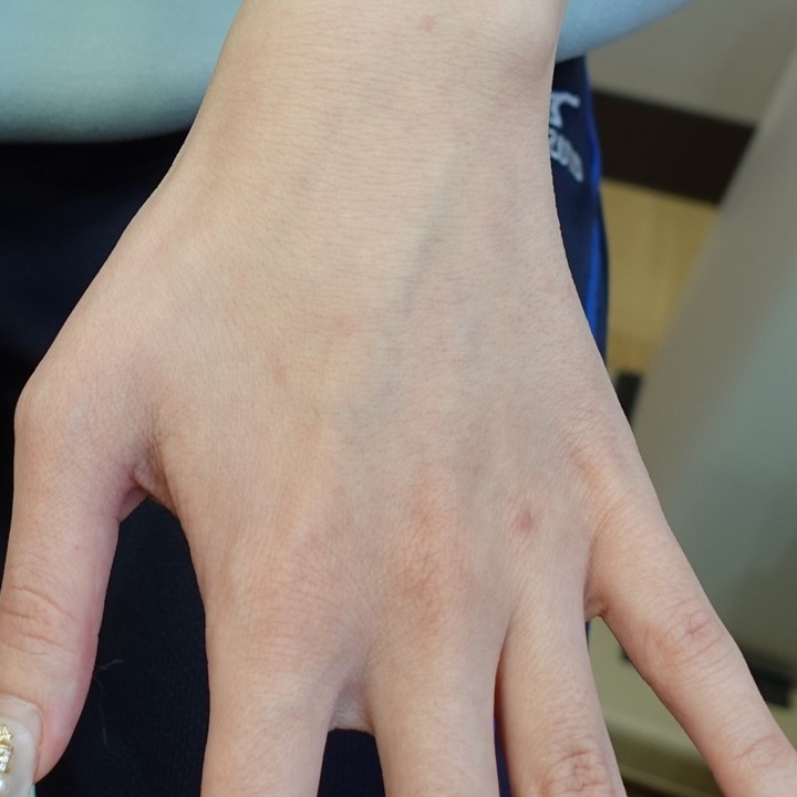 「ヘルペスだと思ったら梅毒だった」―外陰部の潰瘍で見つかった20代女性の症例　When It Looked Like Herpes but Was Actually Syphilis – A Case of Genital Ulcer in a Woman in Her 20s