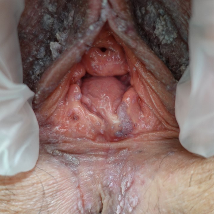 糖尿病治療中に発症した広範な尖圭コンジローマ ― 皮膚ケアと凍結療法で治癒した一例 Extensive Genital Warts in a Woman with Diabetes – Successful Healing with Skin Care and Cryotherapy