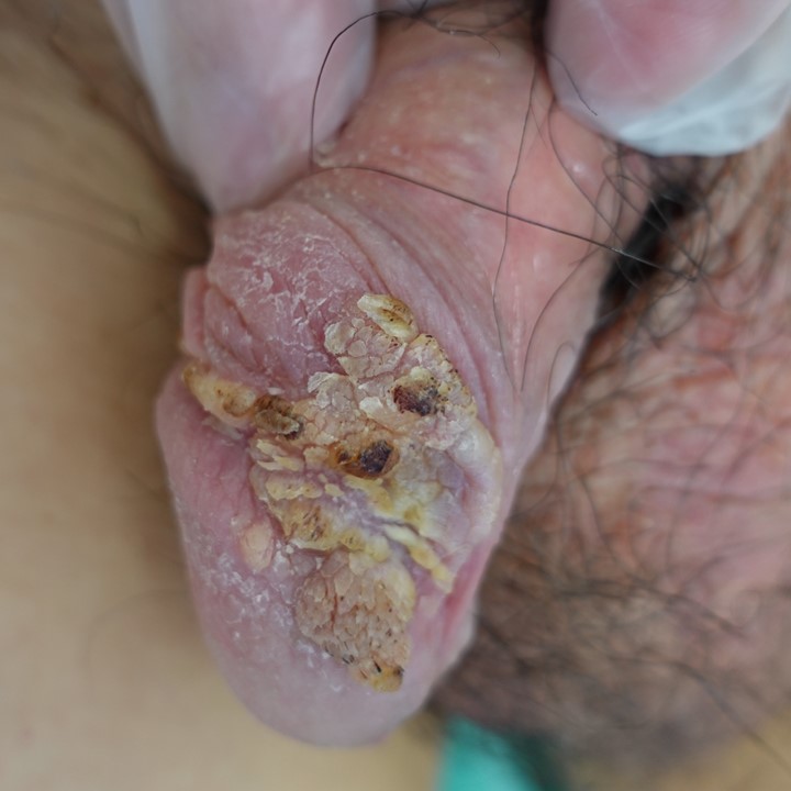 尖圭コンジローマ