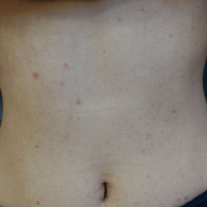 「ヘルペスだと思ったら梅毒だった」―外陰部の潰瘍で見つかった20代女性の症例　When It Looked Like Herpes but Was Actually Syphilis – A Case of Genital Ulcer in a Woman in Her 20s