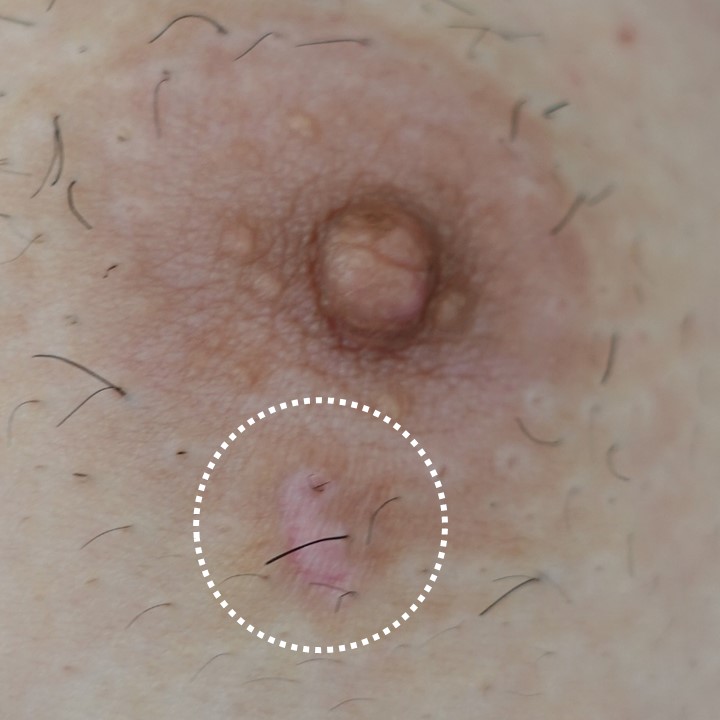 乳輪にできた尖圭コンジローマ