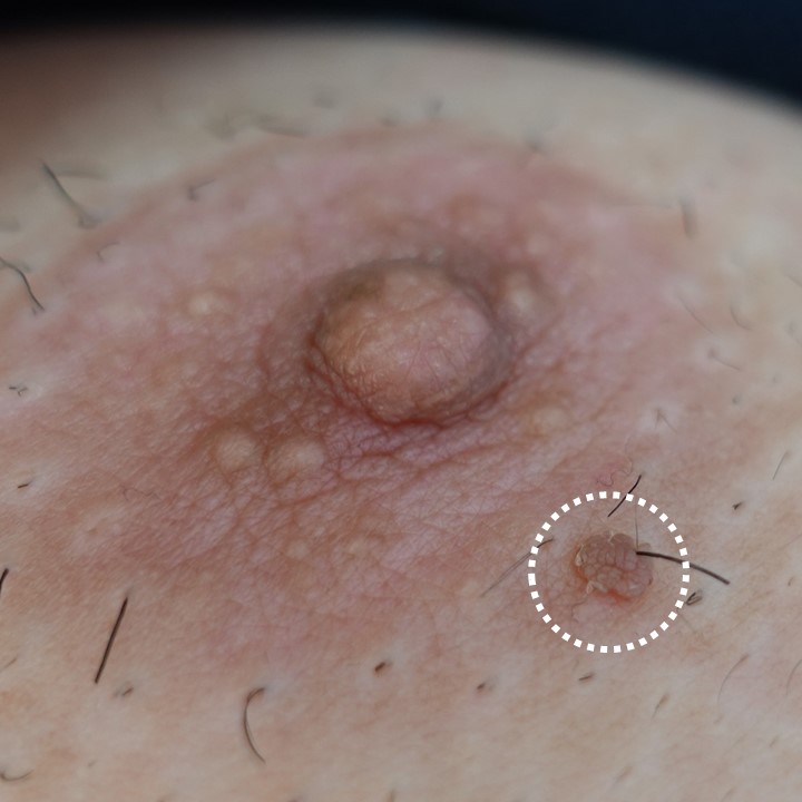乳輪にできた尖圭コンジローマ