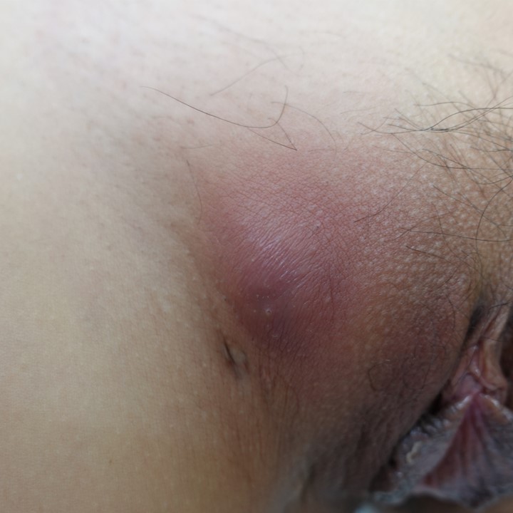 「性病かも？」と心配したら実は違った――鼠径部の皮下膿瘍の症例 “Not an STD After All: A Case of Inguinal Subcutaneous Abscess in a Young Woman”